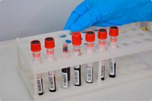 Ліпідограма у діагностиці серцево-судинних захворювань 2