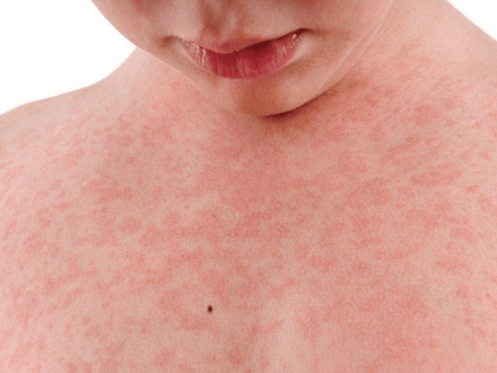 Як правильно здавати аналізи при дитячих інфекційних хворобах 2