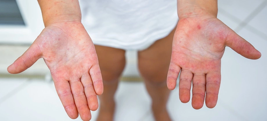 Як правильно здавати аналізи при дитячих інфекційних хворобах 3